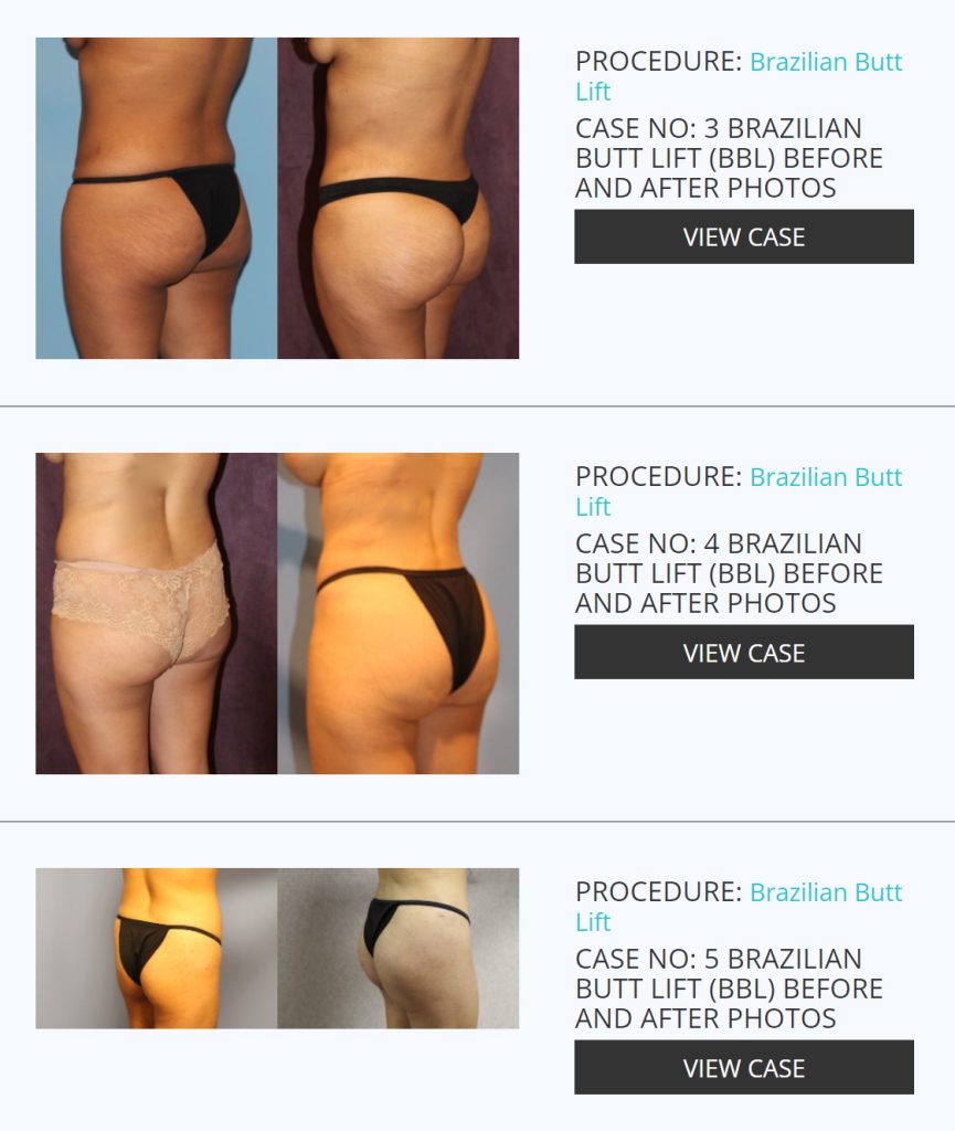 Lift up your lift with Buttock Augmentation Procedure
